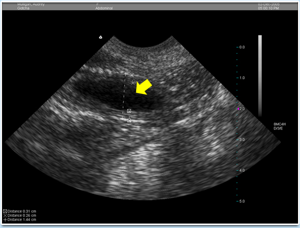 Picture: An infected uterus on ultrasound. The blackened area (indicated by a yellow arrow) shows the infected area.