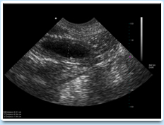 Picture: Ultrasound of uterus.